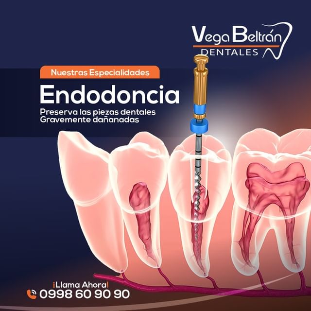 Endodoncia (Salva tu Pieza Dental)